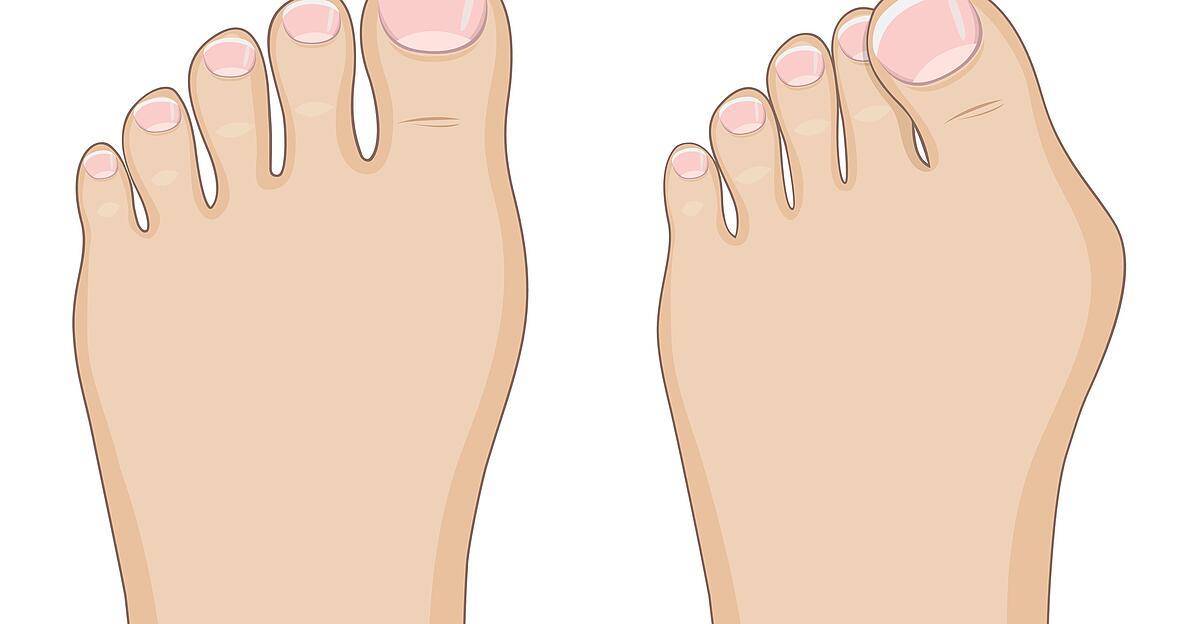 Hallux valgus: Big toe joint going astray - Breaking Latest News