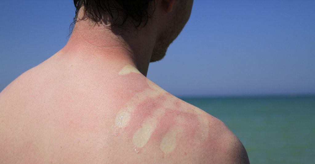 Aloe-vera-Topfen-oder-schwarzer-Tee-Wie-empfehlenswert-sind-Hausmittel-bei-Sonnenbrand-