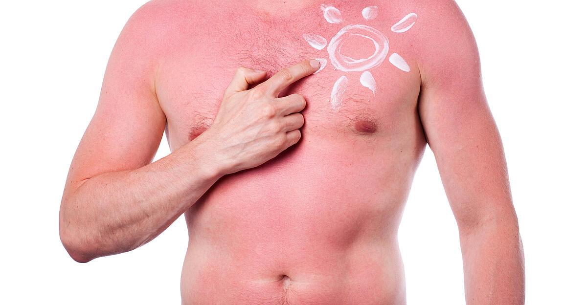 One in three individuals has had a sunburn this 12 months